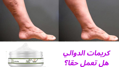 كريمات الدوالي: هل تعمل أم مجرد دعايات؟