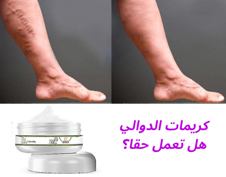 كريمات الدوالي: هل تعمل أم مجرد دعايات؟